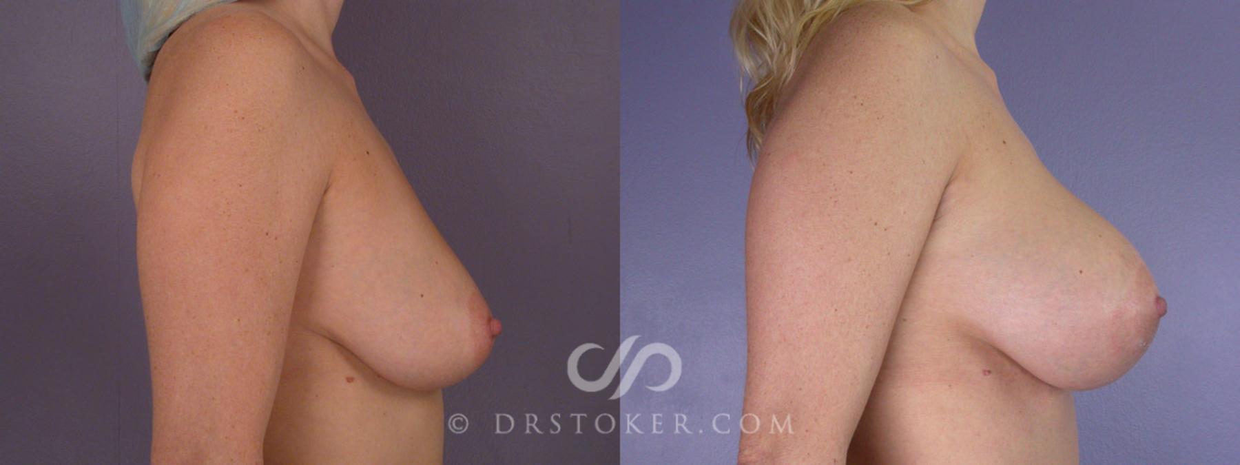 Before & After Breast Augmentation, Rapid Recovery Case 310 View #4 View in Los Angeles, CA
