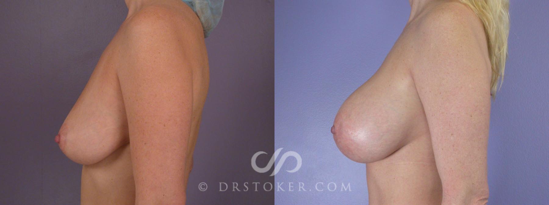 Before & After Breast Augmentation, Rapid Recovery Case 310 View #5 View in Los Angeles, CA