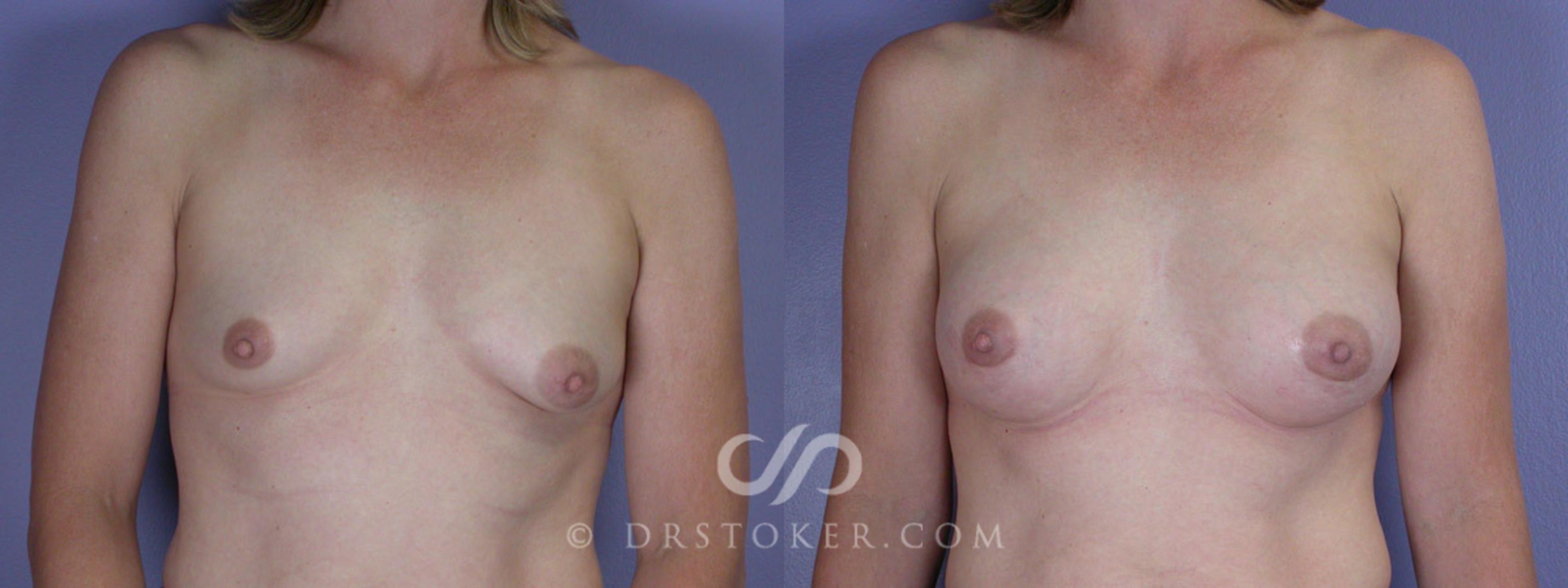 Before & After Breast Augmentation with Lift Case 311 View #1 View in Marina del Rey, CA