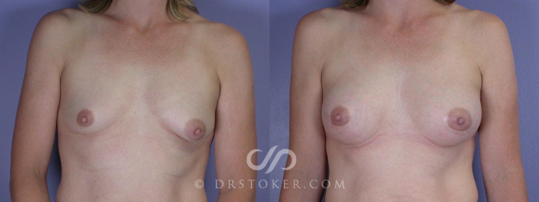 Before & After Breast Augmentation, Rapid Recovery Case 311 View #1 View in Los Angeles, CA