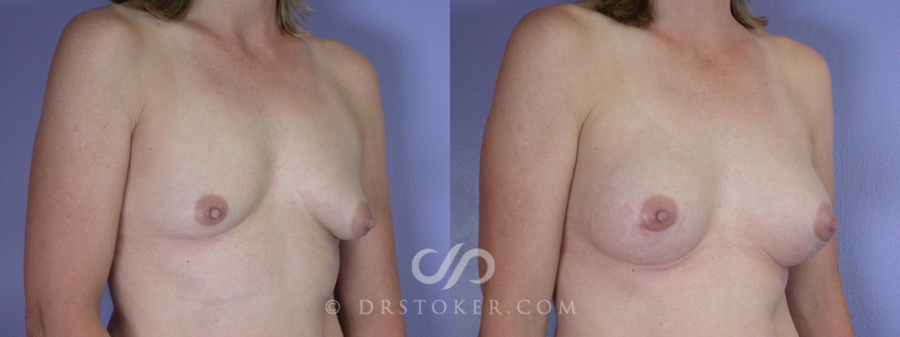 Before & After Breast Augmentation, Rapid Recovery Case 311 View #2 View in Los Angeles, CA