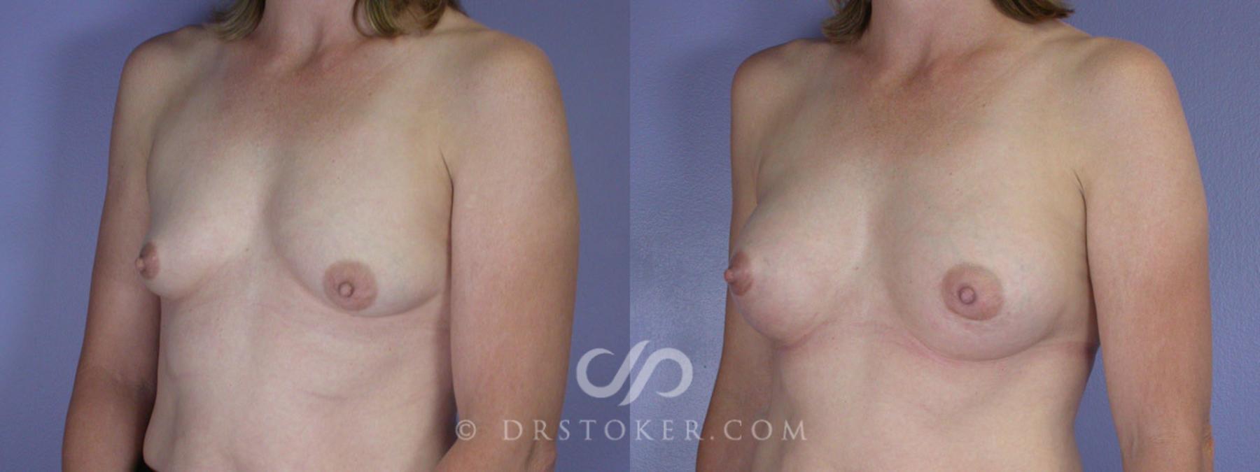 Before & After Breast Augmentation, Rapid Recovery Case 311 View #3 View in Los Angeles, CA