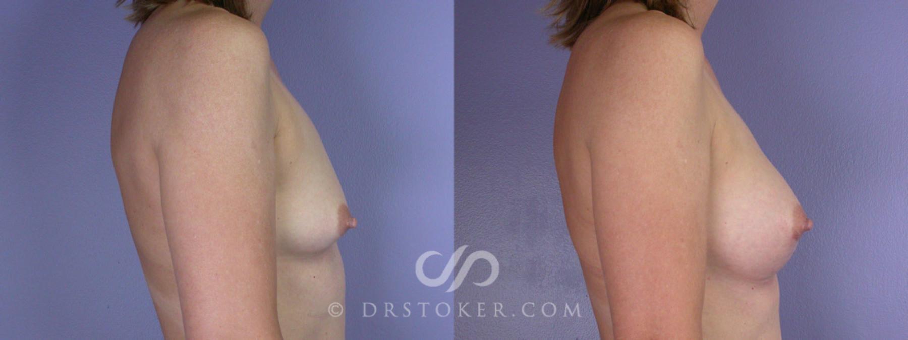 Before & After Breast Augmentation with Lift Case 311 View #4 View in Los Angeles, CA