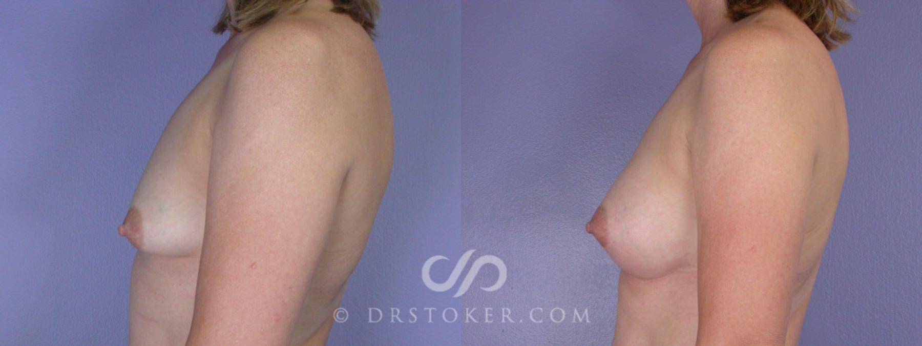 Before & After Breast Asymmetry Correction Case 311 View #5 View in Los Angeles, CA