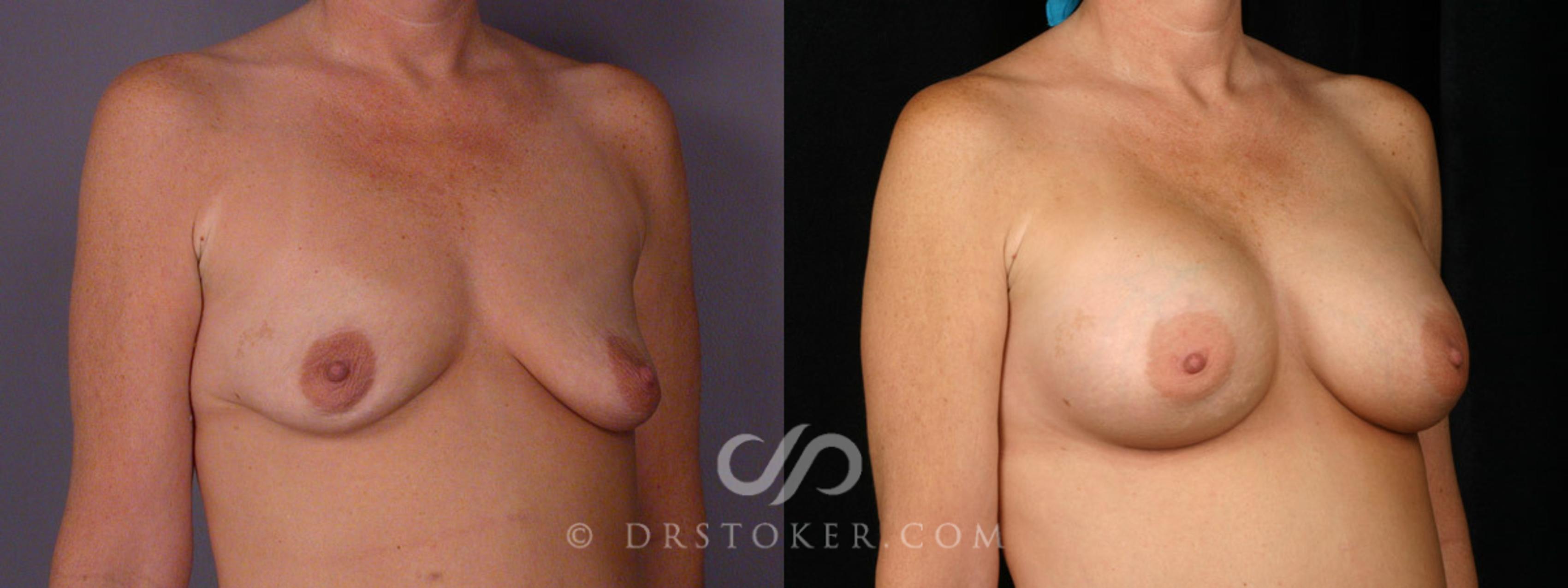 Before & After Breast Augmentation, Rapid Recovery Case 312 View #2 View in Los Angeles, CA