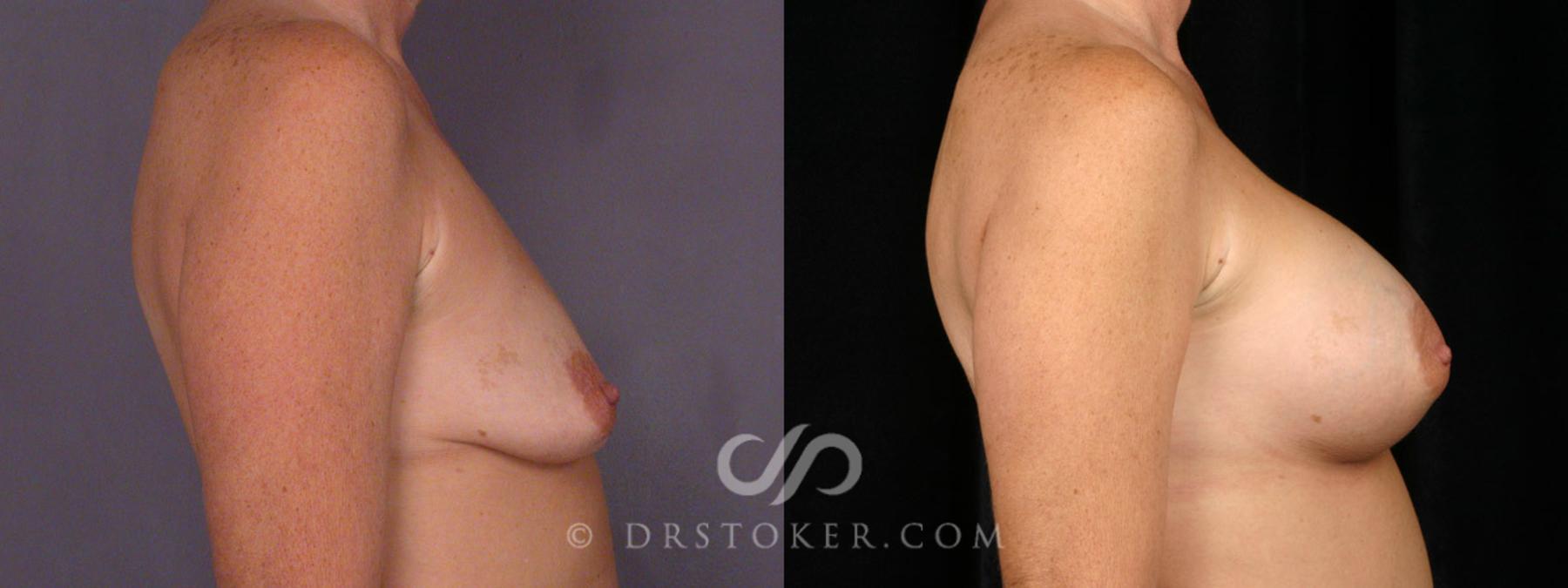Before & After Breast Augmentation, Rapid Recovery Case 312 View #4 View in Los Angeles, CA