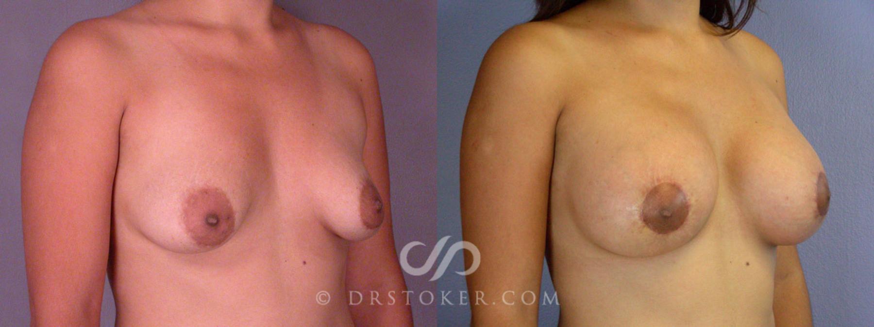 Before & After Breast Lift Case 313 View #2 View in Los Angeles, CA