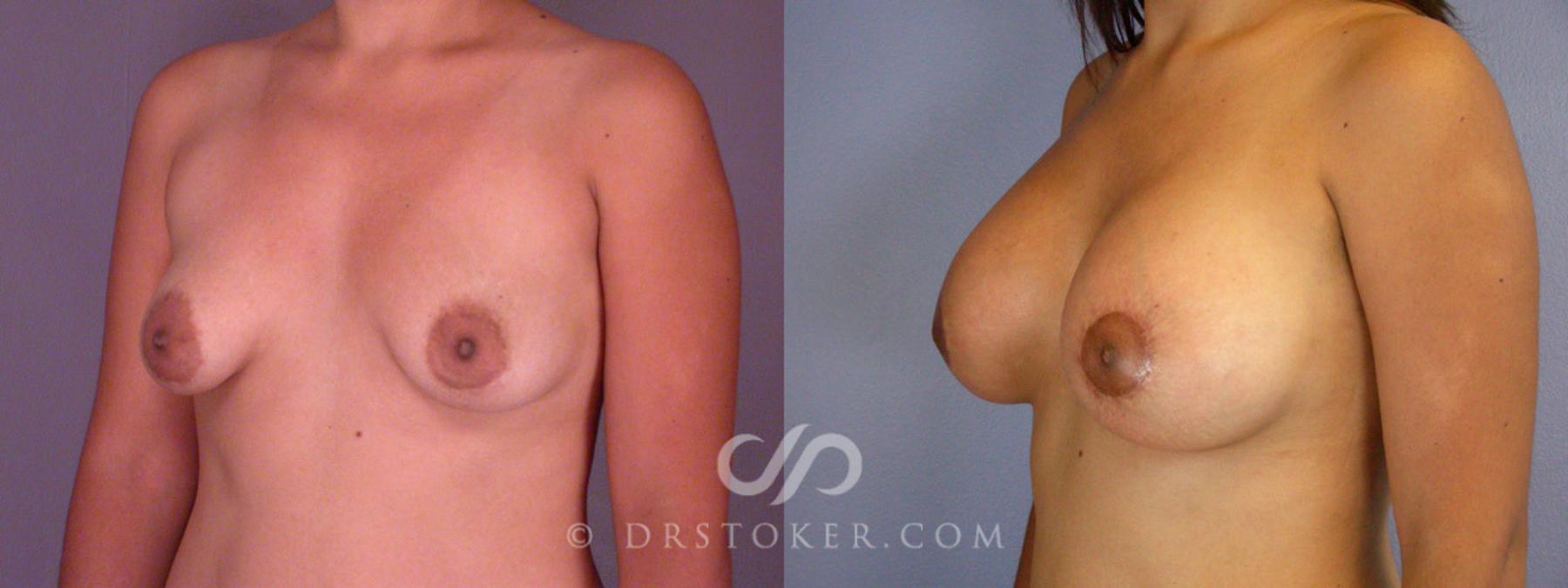 Before & After Breast Augmentation with Lift Case 313 View #3 View in Los Angeles, CA