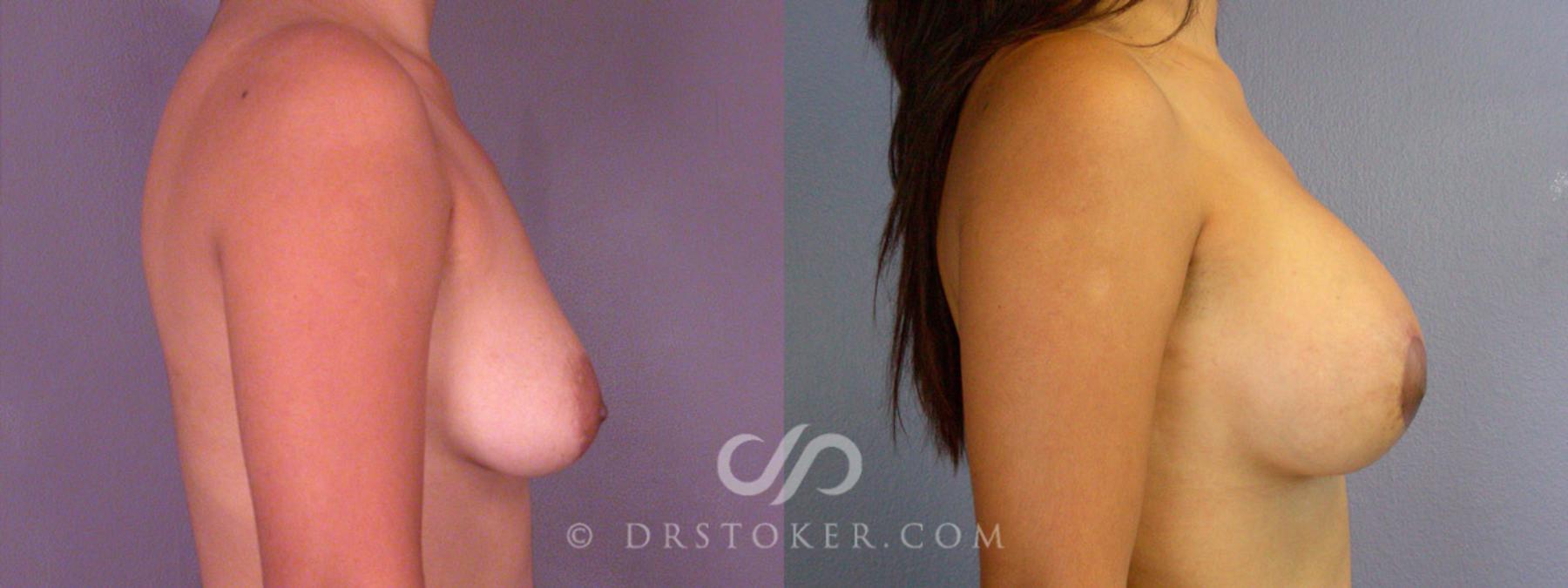 Before & After Breast Augmentation, Rapid Recovery Case 313 View #4 View in Los Angeles, CA