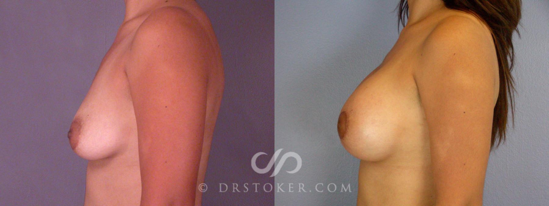 Before & After Breast Augmentation with Lift Case 313 View #5 View in Los Angeles, CA