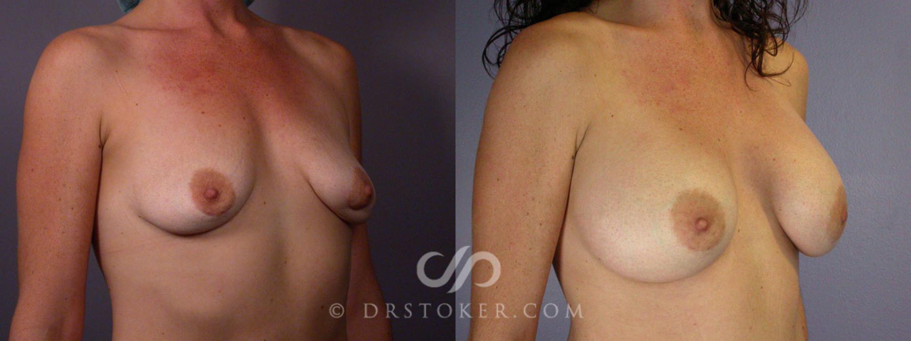 Before & After Breast Asymmetry Correction Case 330 View #3 View in Los Angeles, CA