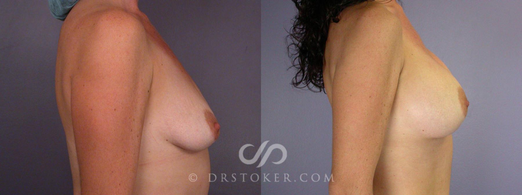 Before & After Breast Asymmetry Correction Case 330 View #4 View in Los Angeles, CA