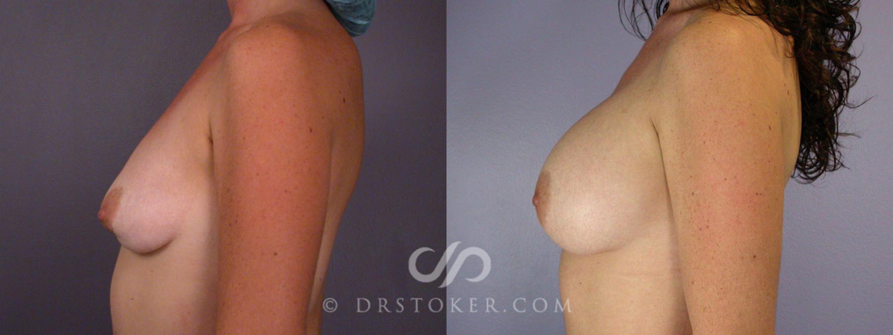 Before & After Breast Implant Correction Case 330 View #5 View in Los Angeles, CA