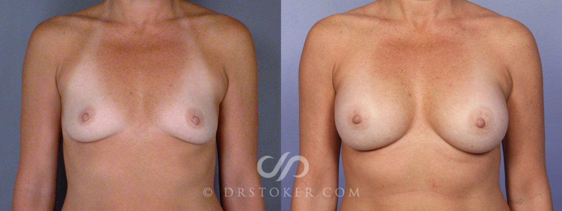 Before & After Breast Augmentation, Rapid Recovery Case 340 View #1 View in Los Angeles, CA