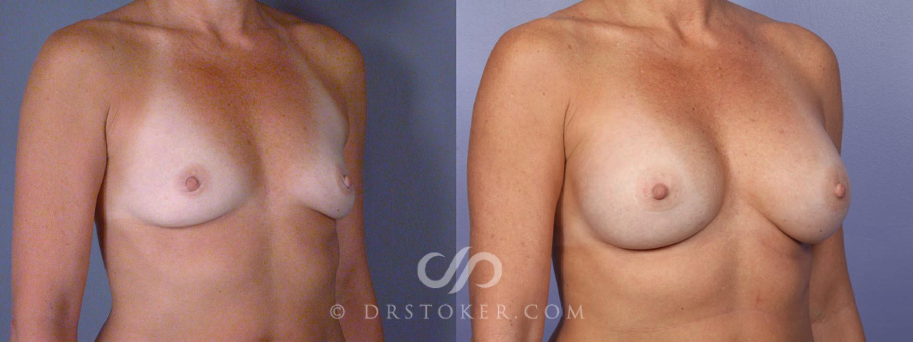 Before & After Breast Augmentation, Rapid Recovery Case 340 View #2 View in Los Angeles, CA