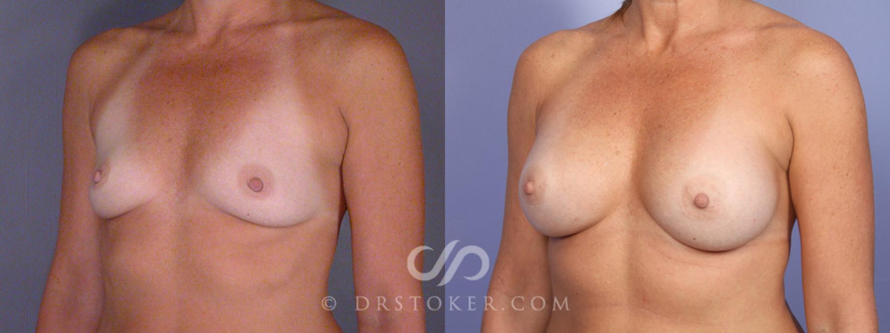Before & After Breast Augmentation, Rapid Recovery Case 340 View #3 View in Los Angeles, CA
