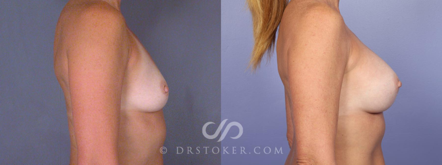 Before & After Breast Augmentation, Rapid Recovery Case 340 View #4 View in Los Angeles, CA