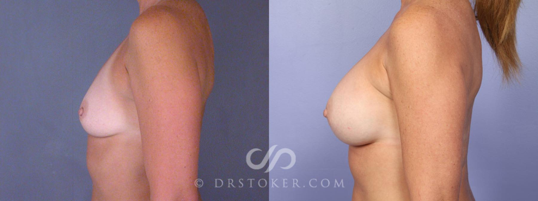 Before & After Breast Augmentation, Rapid Recovery Case 340 View #5 View in Los Angeles, CA