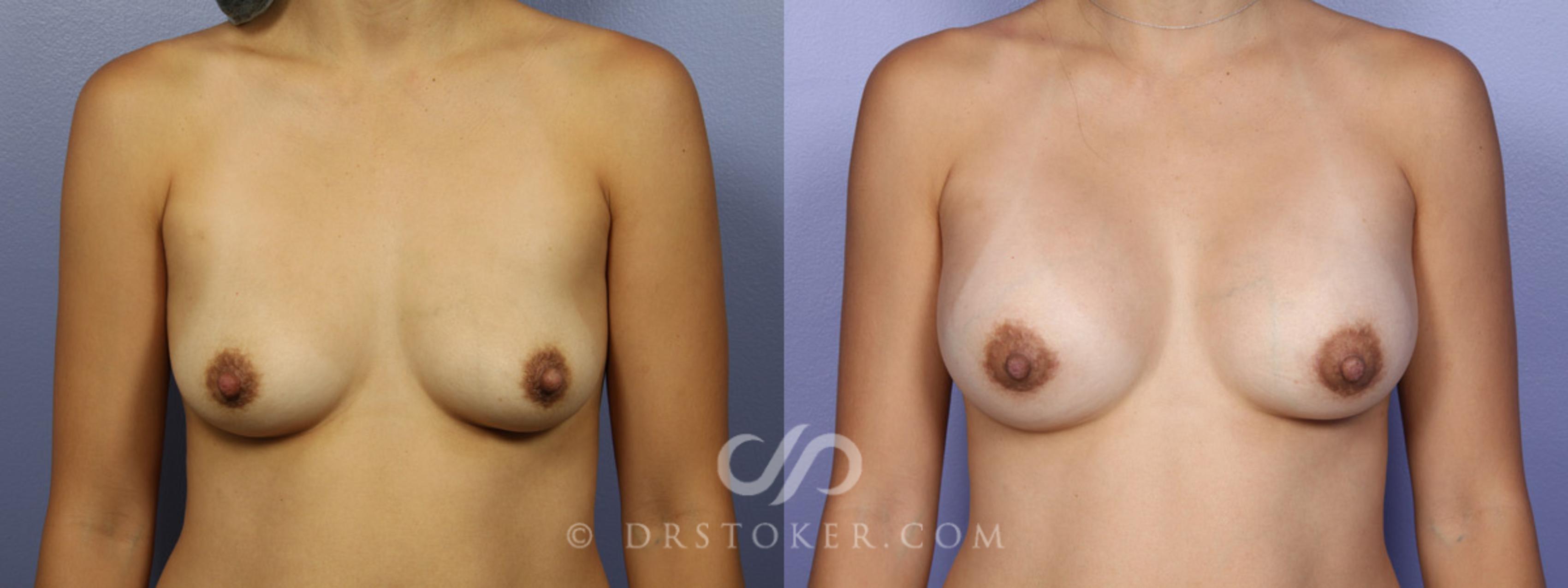 Before & After Breast Augmentation, Rapid Recovery Case 347 View #1 View in Los Angeles, CA