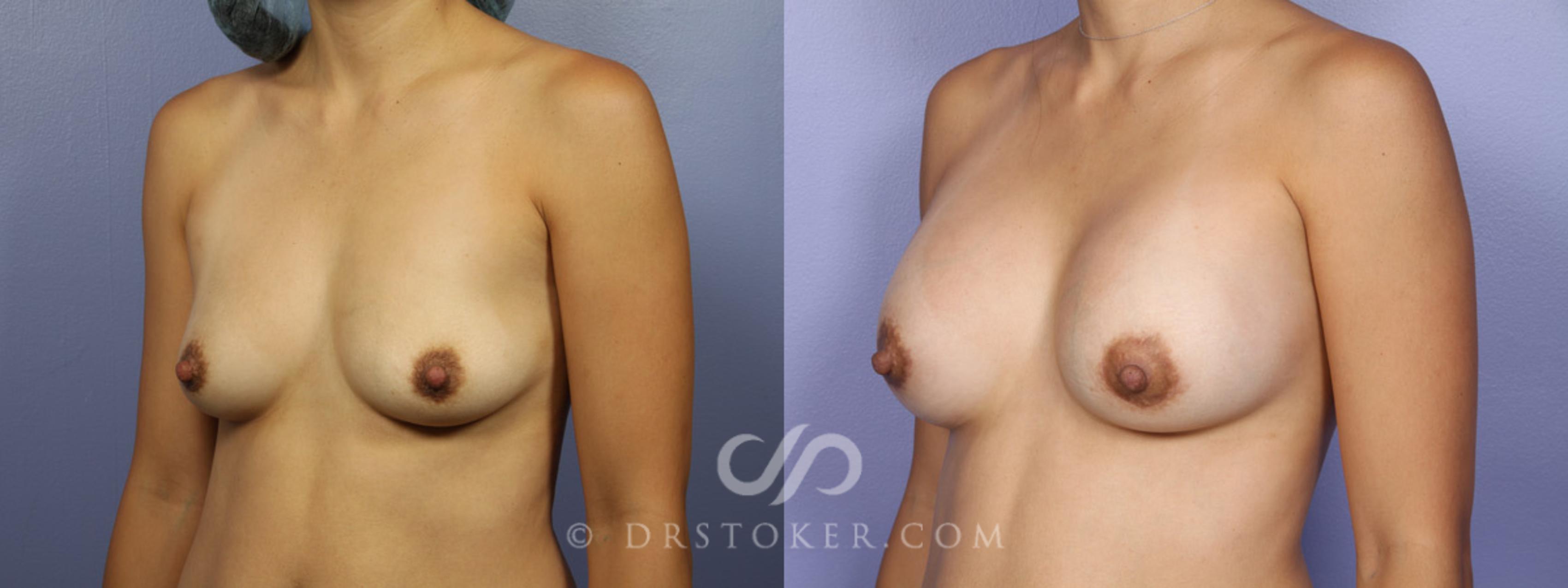 Before & After Breast Augmentation, Rapid Recovery Case 347 View #3 View in Los Angeles, CA