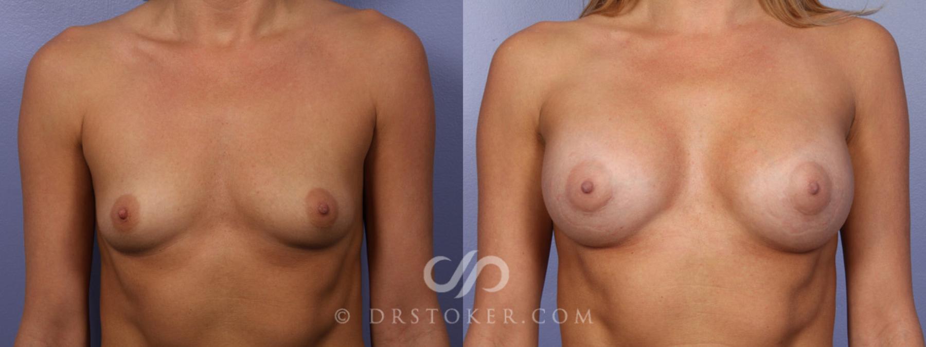 Before & After Breast Augmentation, Rapid Recovery Case 356 View #1 View in Los Angeles, CA