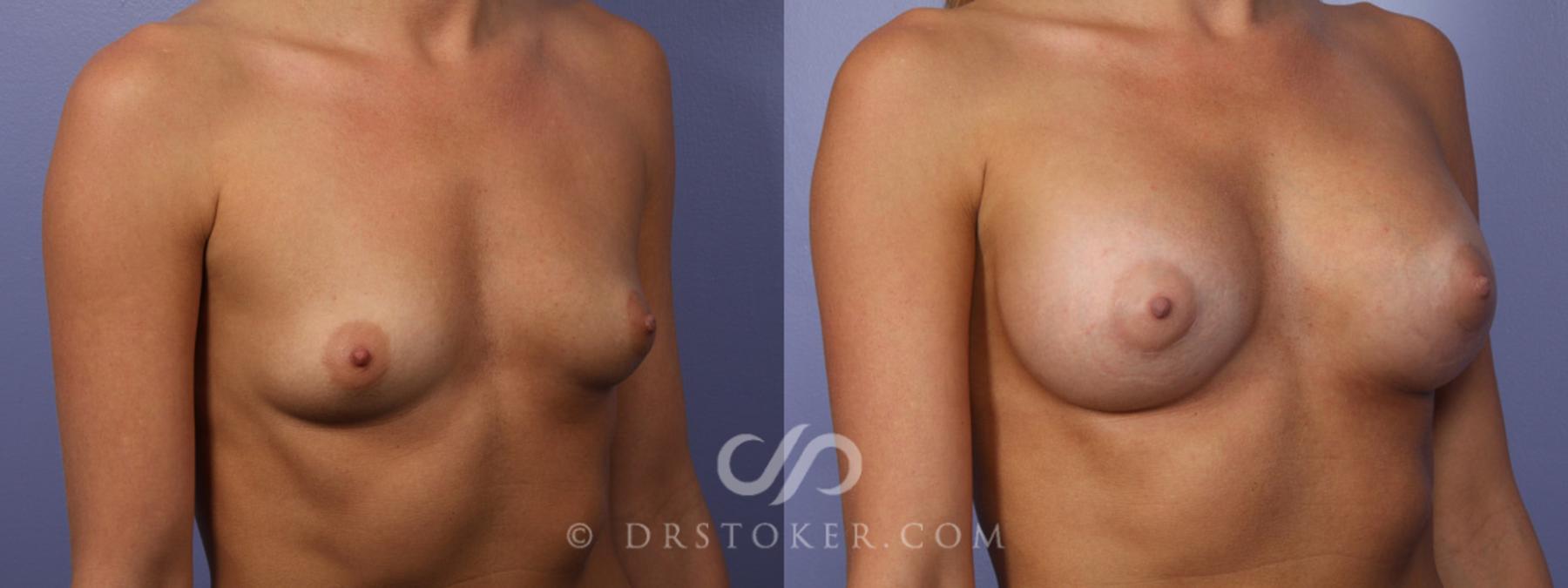 Before & After Breast Augmentation, Rapid Recovery Case 356 View #2 View in Los Angeles, CA