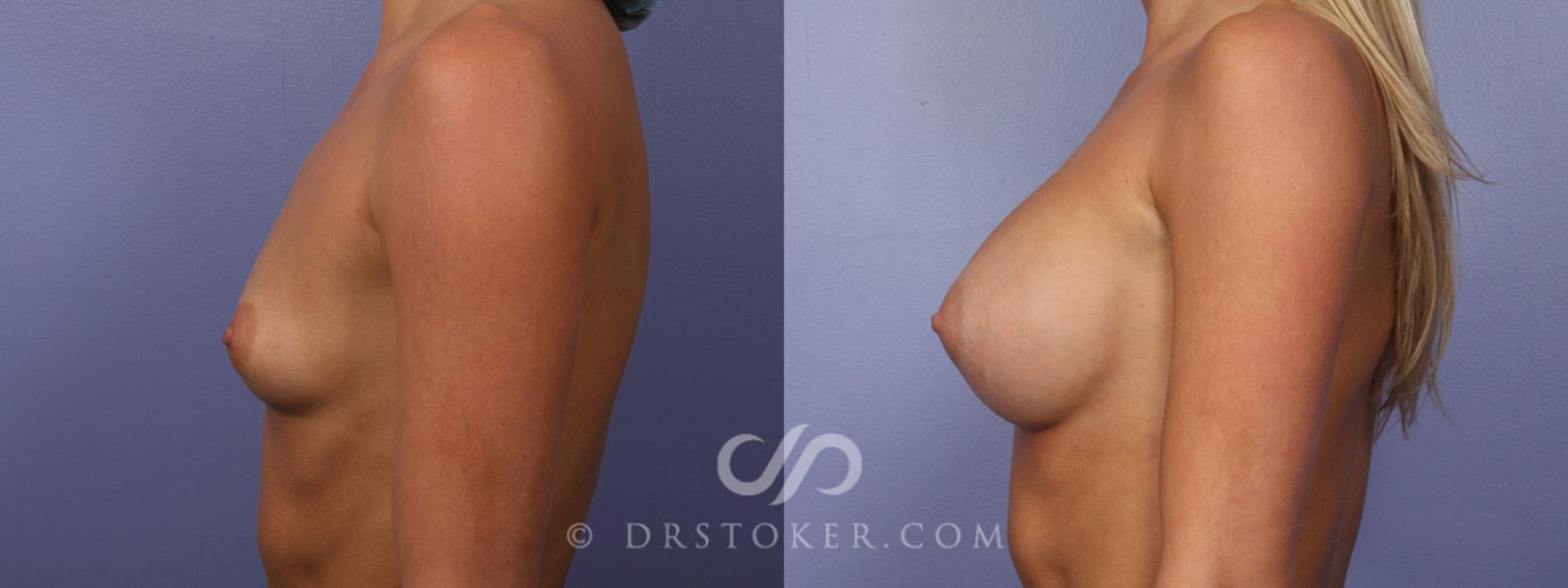 Before & After Breast Augmentation, Rapid Recovery Case 356 View #5 View in Los Angeles, CA
