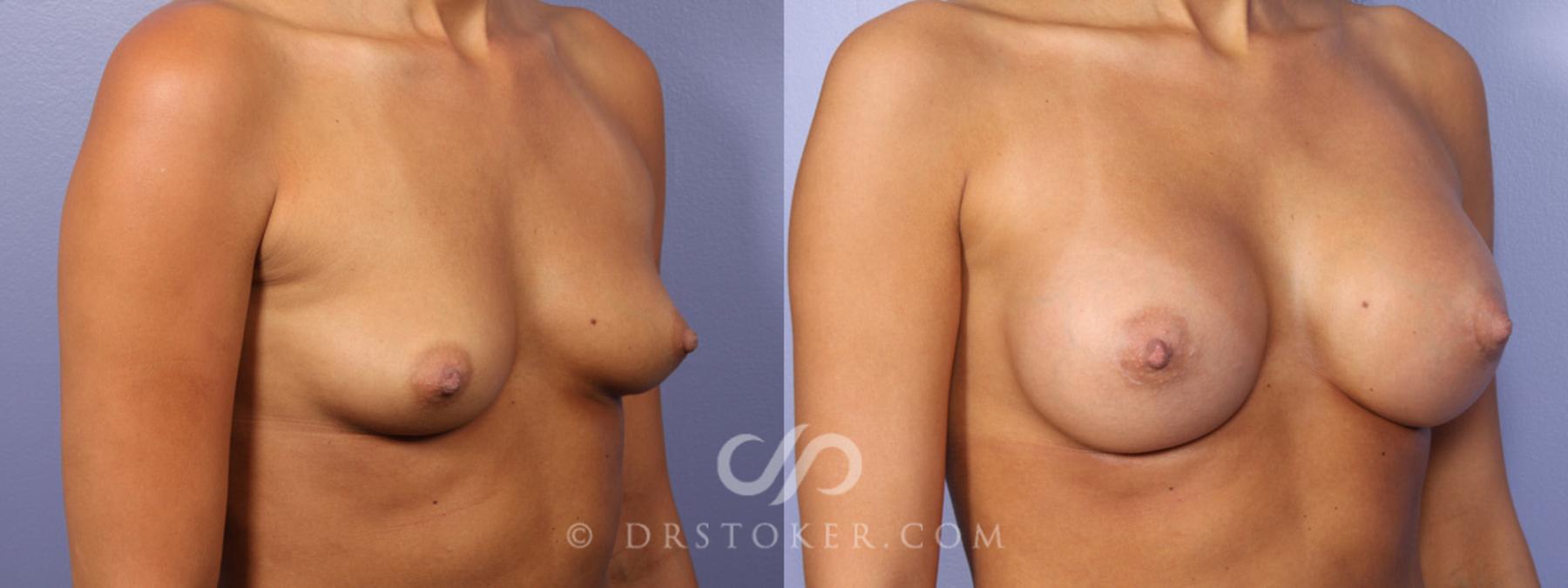 Before & After Breast Augmentation, Rapid Recovery Case 357 View #2 View in Los Angeles, CA