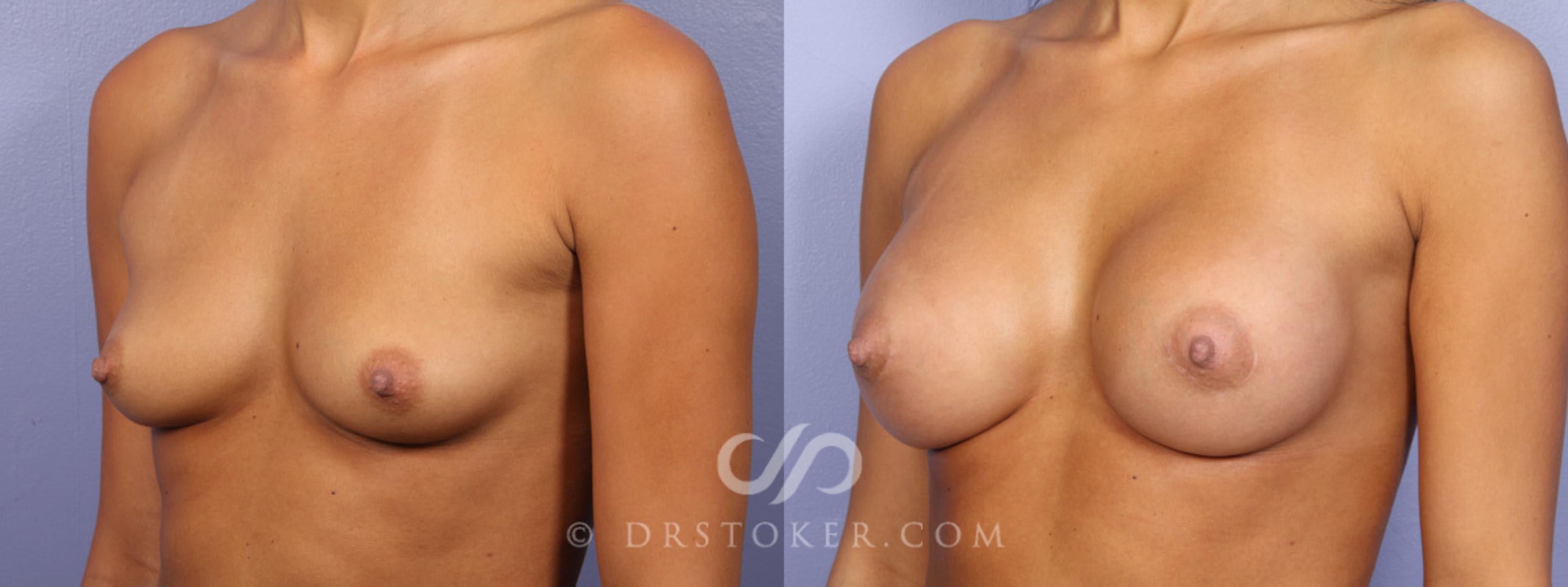 Before & After Breast Augmentation, Rapid Recovery Case 357 View #3 View in Los Angeles, CA