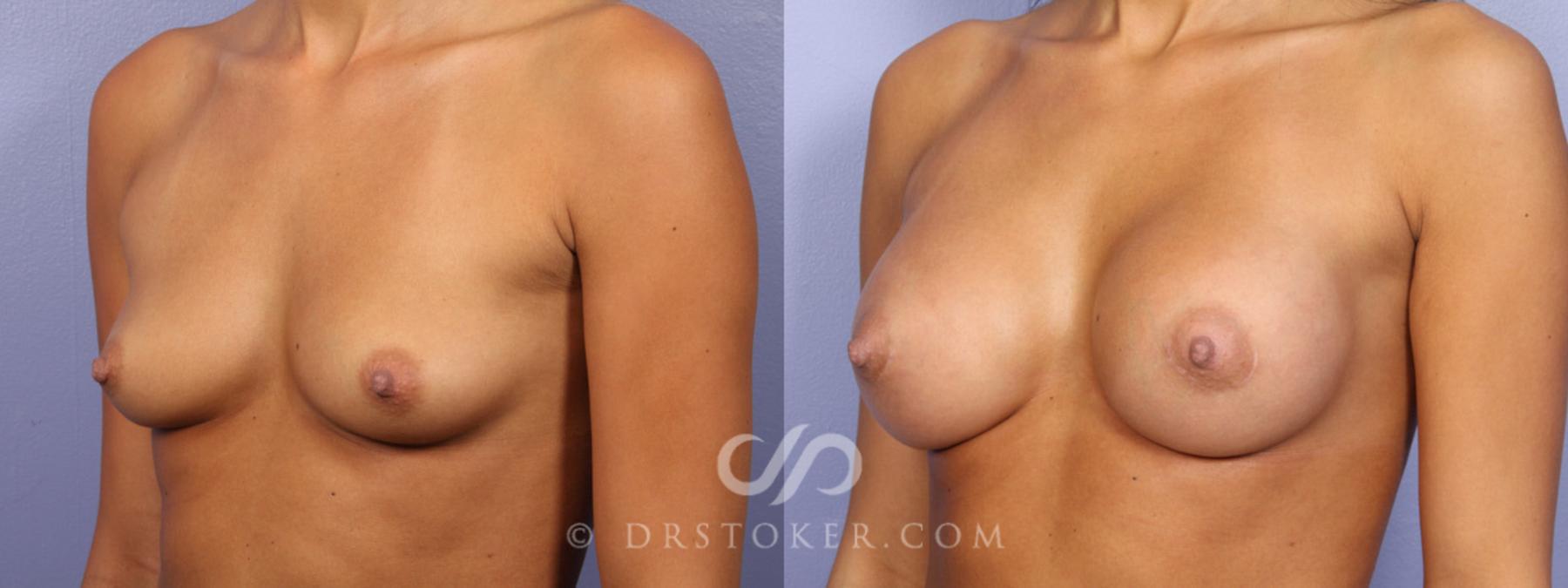 Before & After Breast Augmentation, Rapid Recovery Case 357 View #3 View in Los Angeles, CA