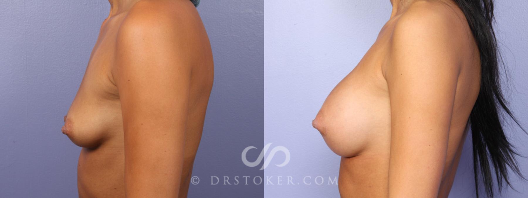 Before & After Breast Augmentation, Rapid Recovery Case 357 View #5 View in Los Angeles, CA