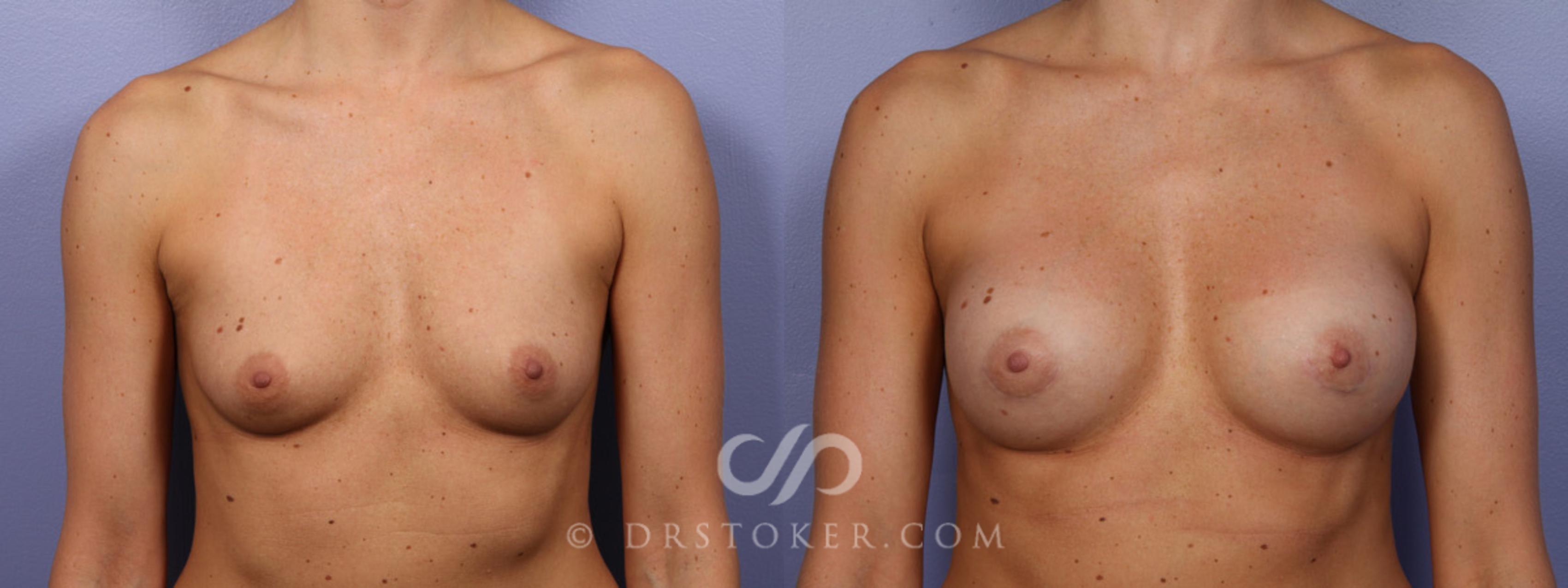 Before & After Breast Augmentation, Rapid Recovery Case 358 View #1 View in Los Angeles, CA