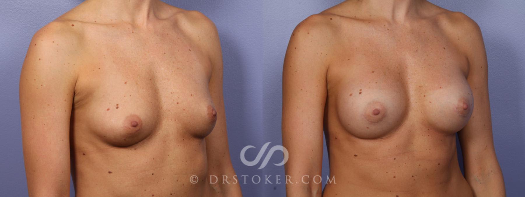 Before & After Breast Augmentation, Rapid Recovery Case 358 View #2 View in Los Angeles, CA