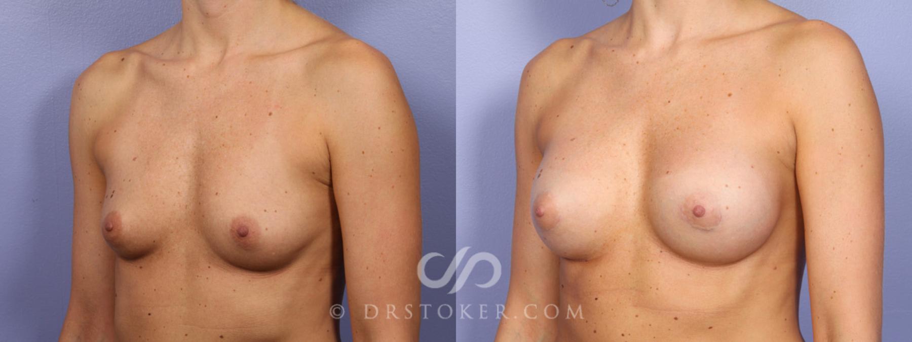 Before & After Breast Augmentation, Rapid Recovery Case 358 View #3 View in Los Angeles, CA