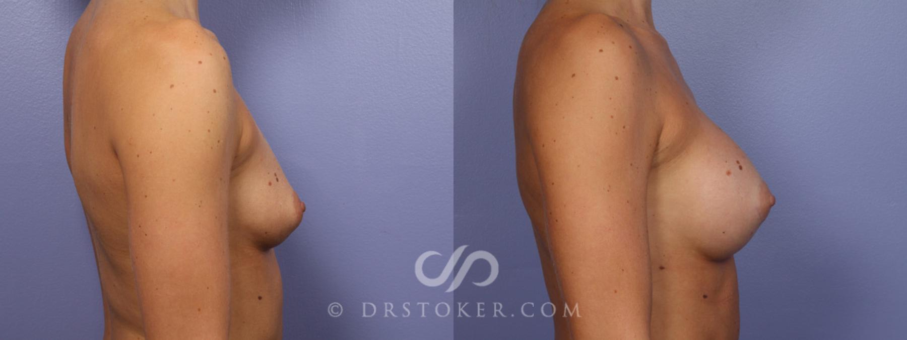 Before & After Breast Augmentation, Rapid Recovery Case 358 View #4 View in Los Angeles, CA