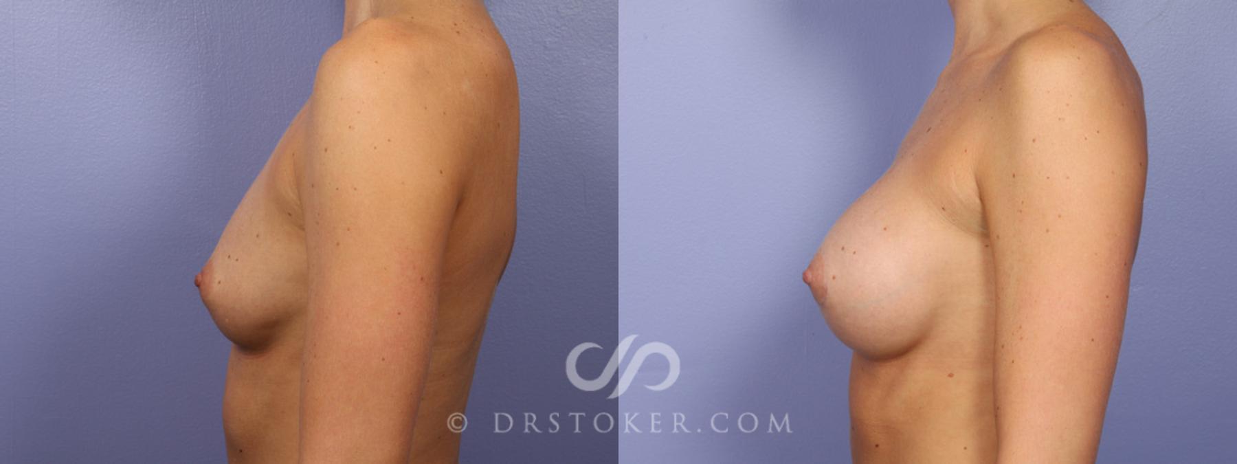 Before & After Breast Augmentation, Rapid Recovery Case 358 View #5 View in Los Angeles, CA