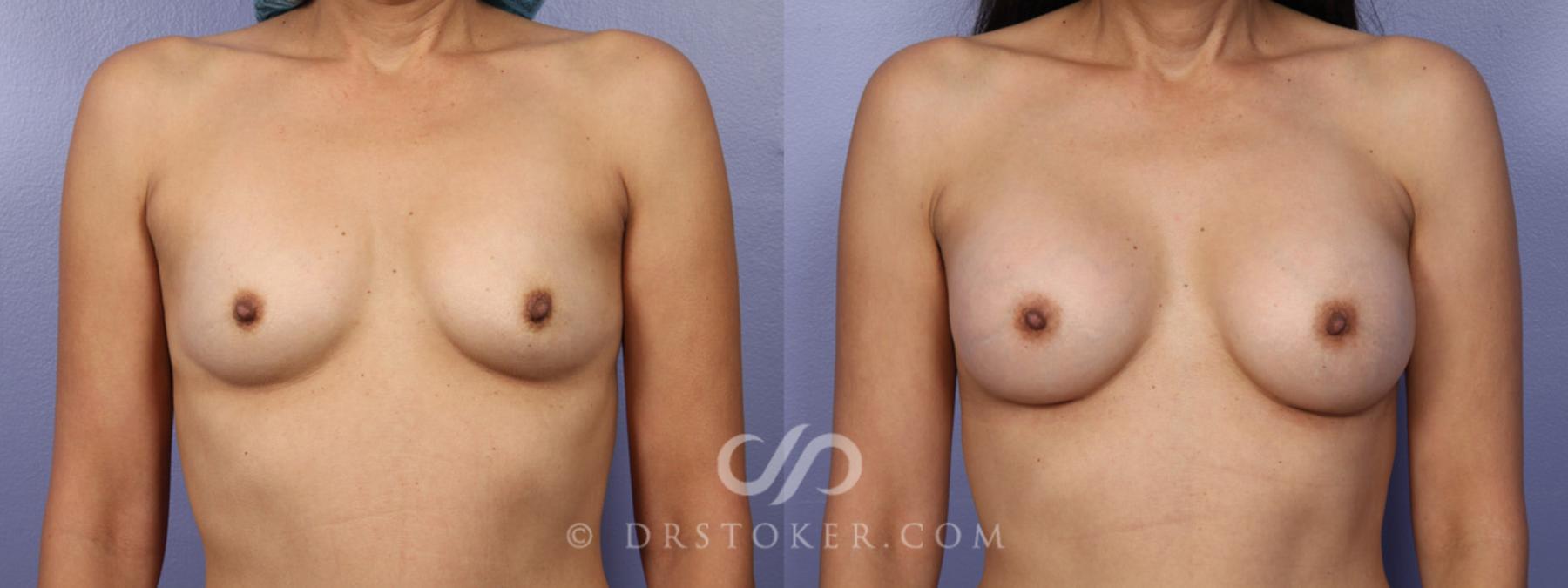 Before & After Breast Augmentation, Rapid Recovery Case 359 View #1 View in Los Angeles, CA