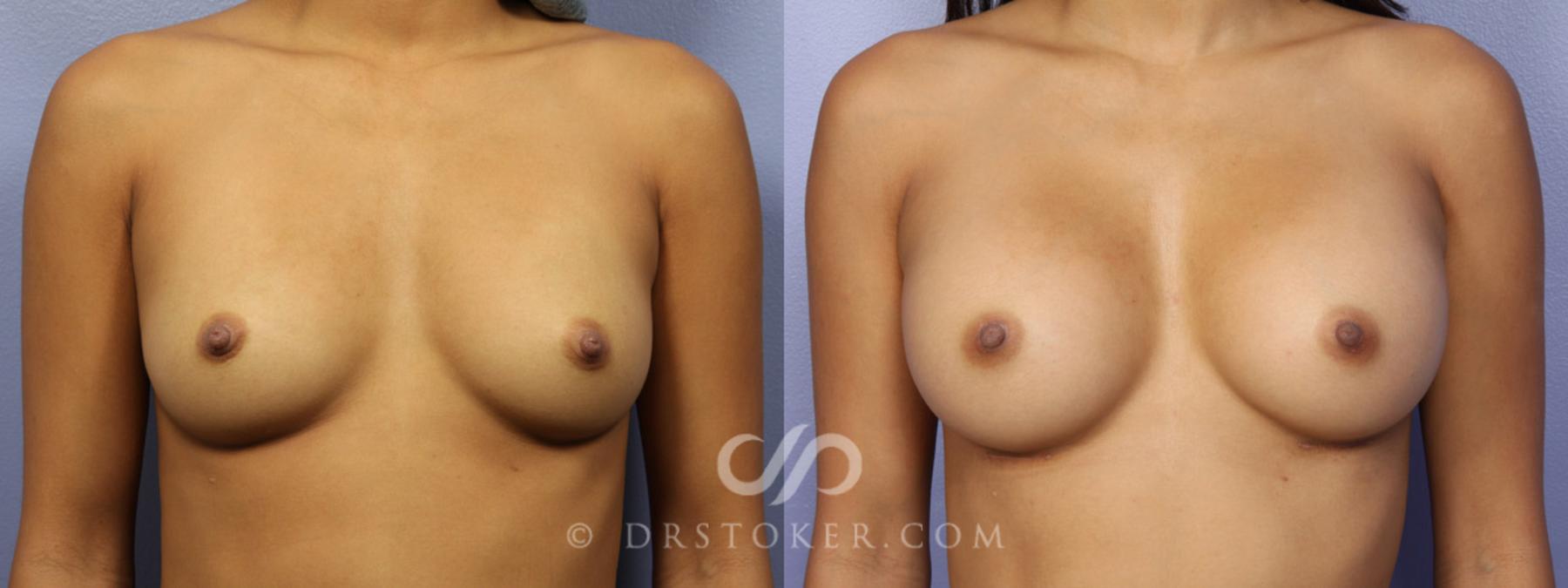 Before & After Breast Augmentation, Rapid Recovery Case 360 View #1 View in Los Angeles, CA