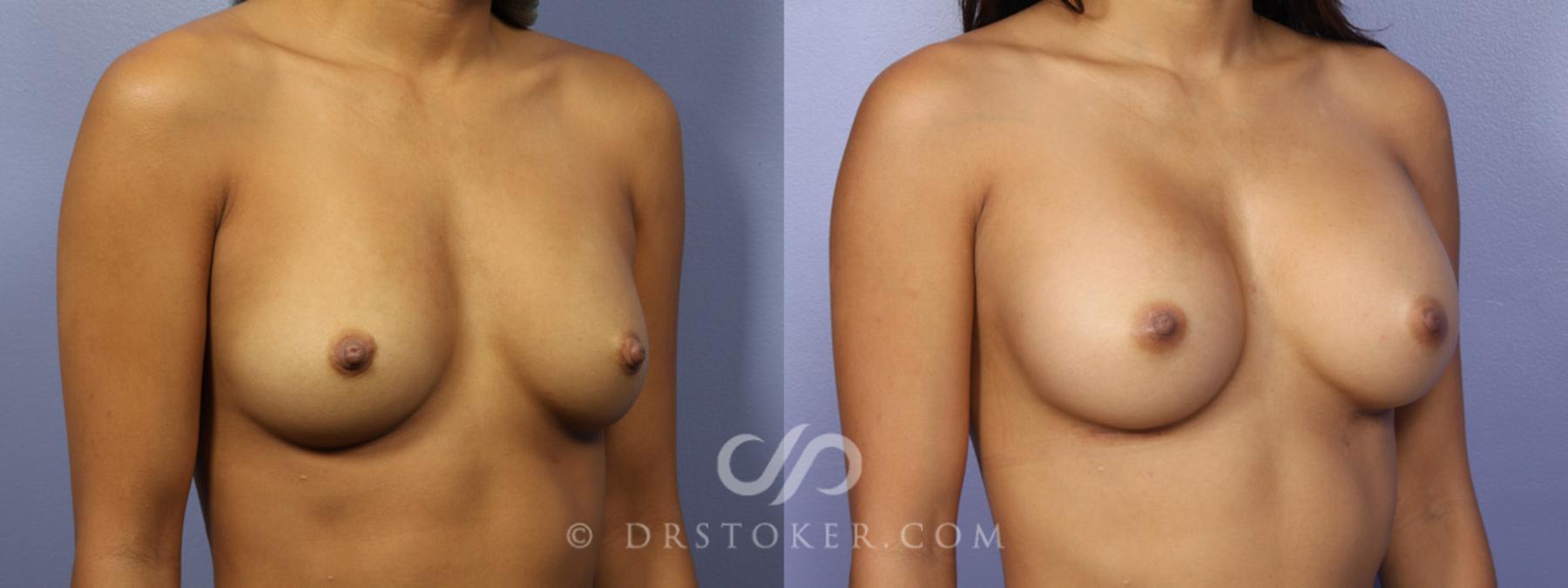 Before & After Breast Augmentation, Rapid Recovery Case 360 View #2 View in Los Angeles, CA