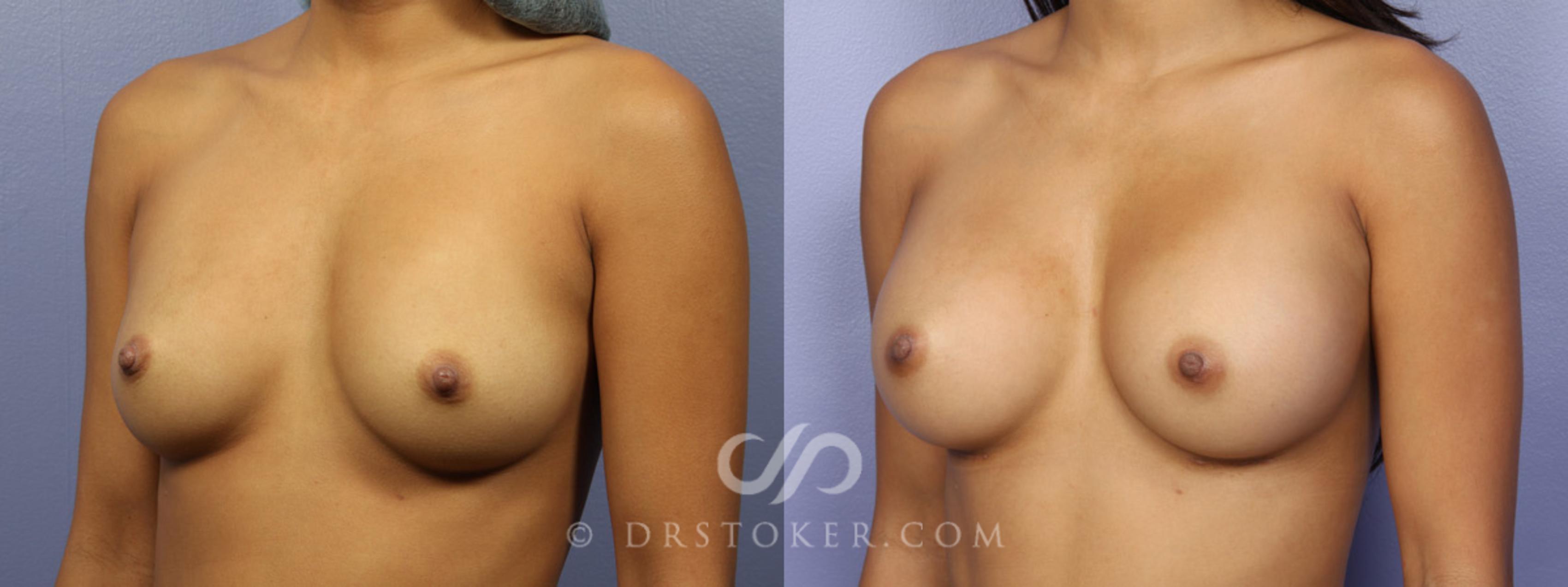 Before & After Breast Augmentation, Rapid Recovery Case 360 View #3 View in Los Angeles, CA