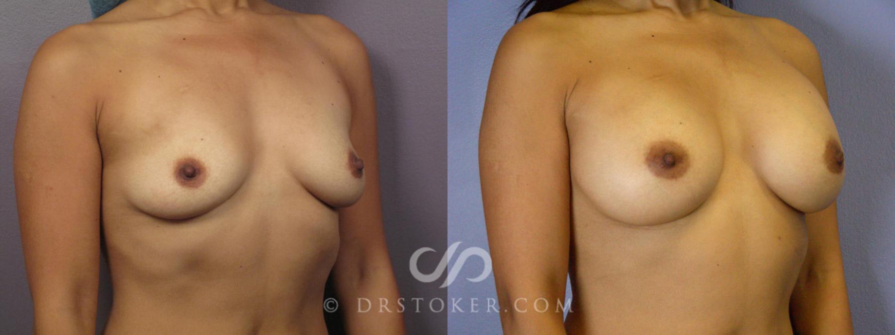 Before & After Breast Augmentation, Rapid Recovery Case 364 View #2 View in Los Angeles, CA