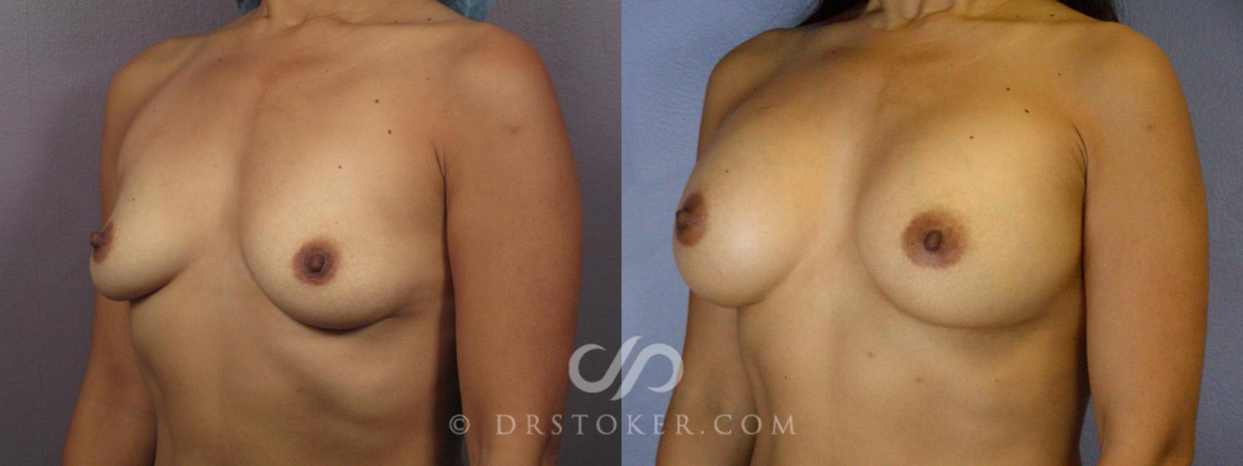 Before & After Breast Augmentation, Rapid Recovery Case 364 View #3 View in Los Angeles, CA
