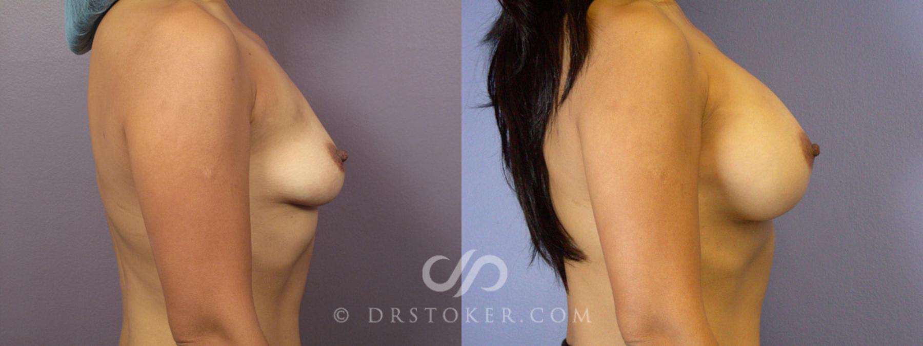 Before & After Breast Augmentation, Rapid Recovery Case 364 View #4 View in Los Angeles, CA