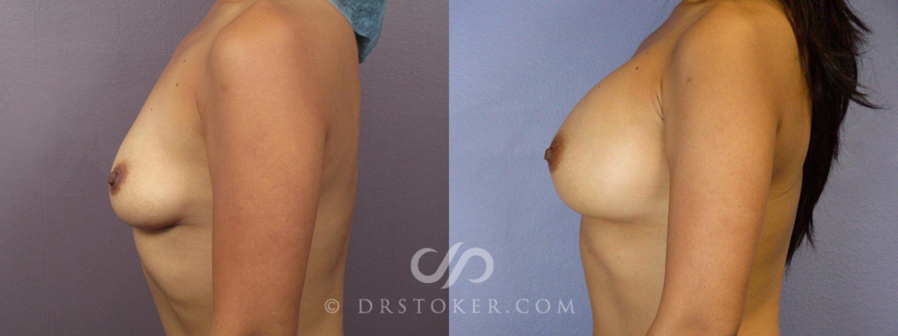 Before & After Breast Augmentation, Rapid Recovery Case 364 View #5 View in Los Angeles, CA