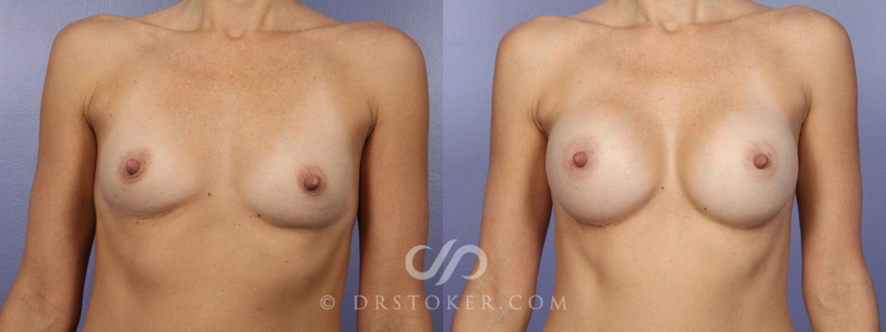 Before & After Breast Augmentation, Rapid Recovery Case 365 View #1 View in Los Angeles, CA