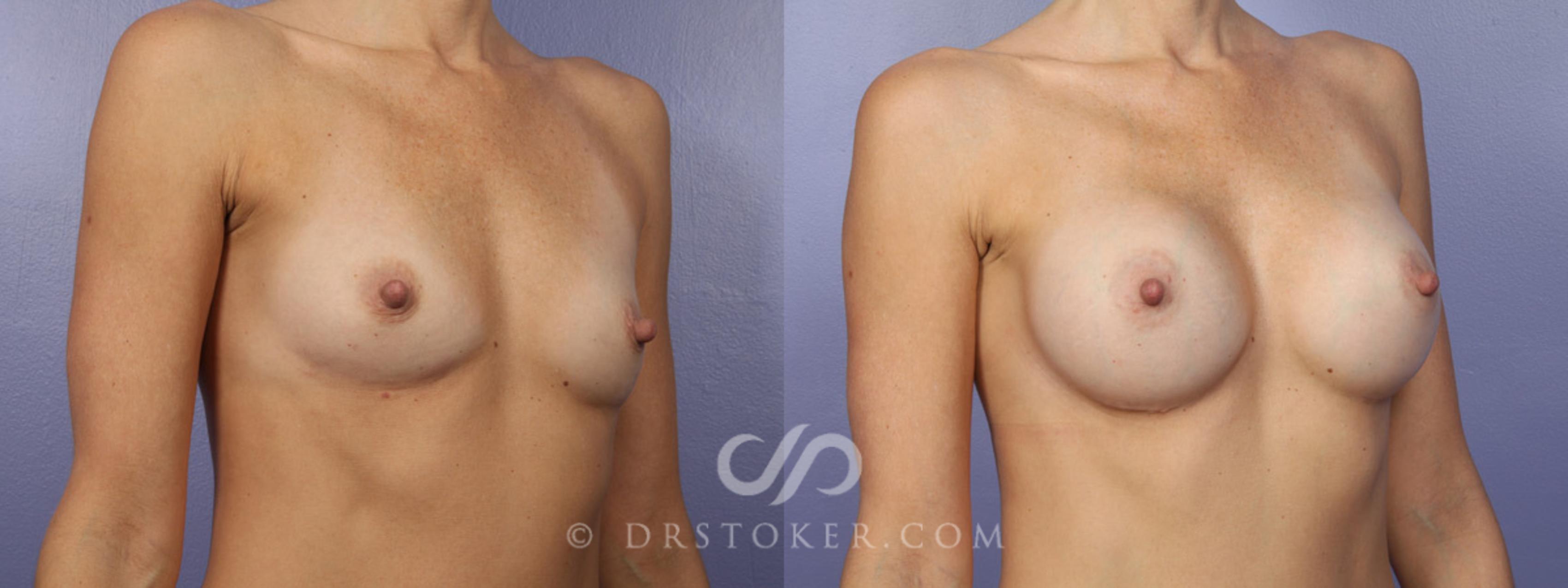 Before & After Breast Augmentation, Rapid Recovery Case 365 View #2 View in Los Angeles, CA