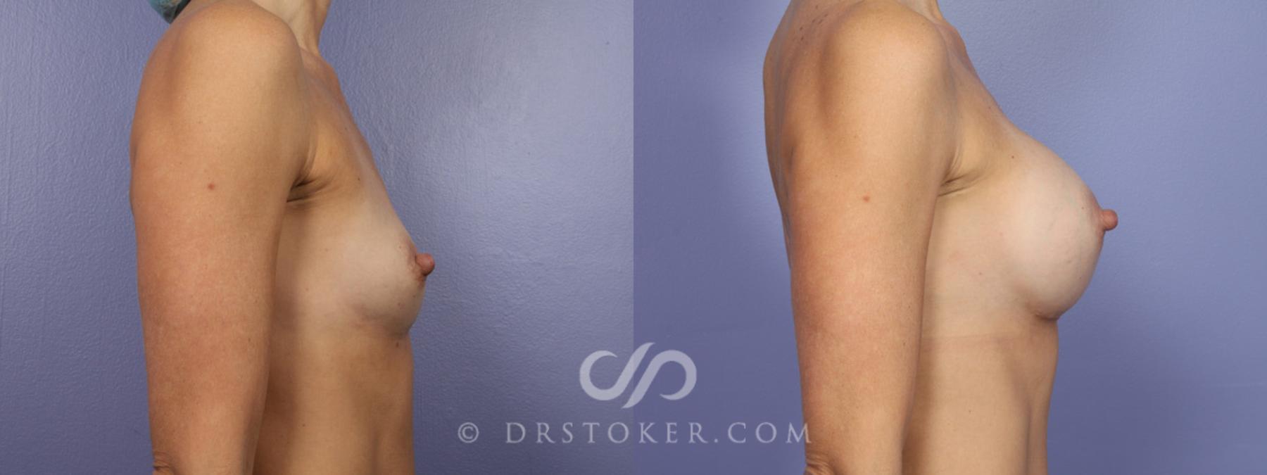 Before & After Breast Augmentation, Rapid Recovery Case 365 View #4 View in Los Angeles, CA