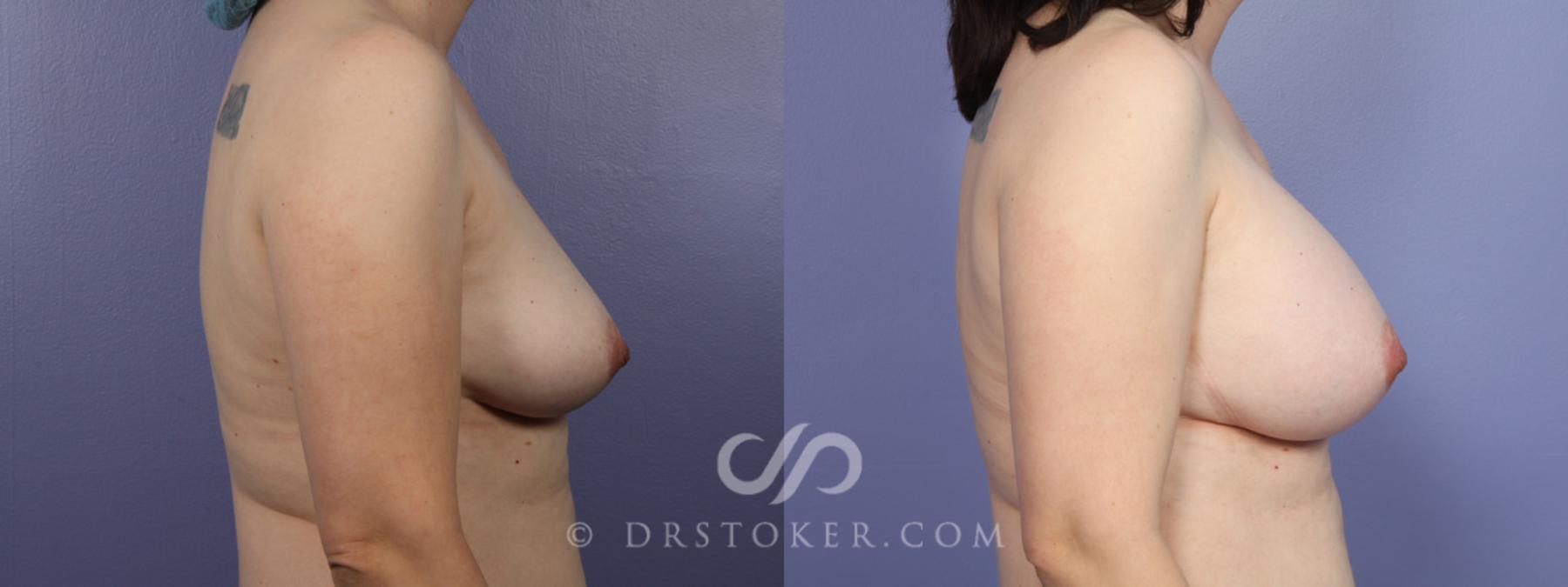 Before & After Breast Augmentation, Rapid Recovery Case 367 View #4 View in Los Angeles, CA