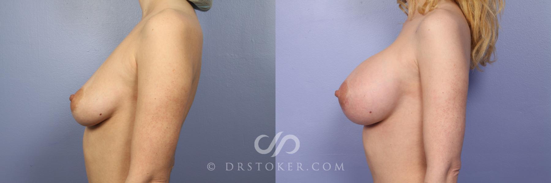 Before & After Breast Augmentation, Rapid Recovery Case 378 View #2 View in Los Angeles, CA
