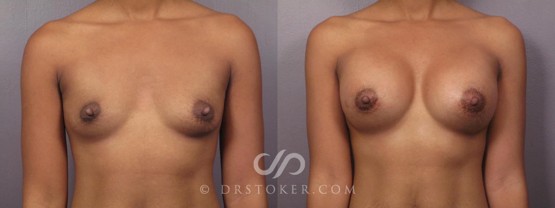 Before & After Breast Augmentation, Rapid Recovery Case 384 View #1 View in Los Angeles, CA